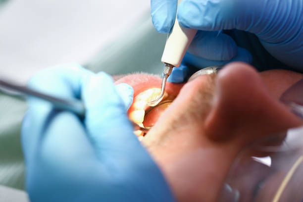Best Emergency Dentist for Knocked-Out Tooth in Clintondale, NY